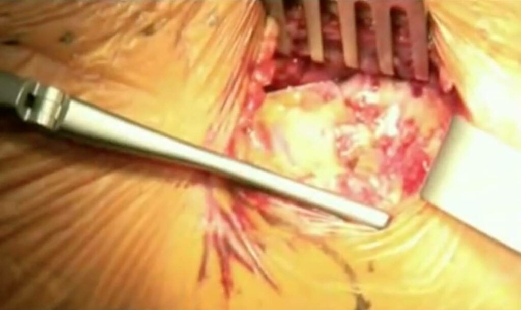 Hip replacement videos